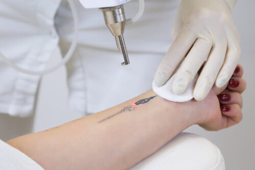 Laserowe usuwanie tatuażu – czy to bolesne?