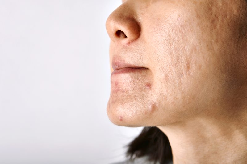 Atopowe zapalenie skóry – czym jest?